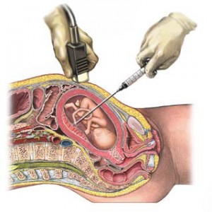 cordoncentesis