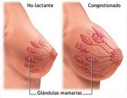 Insurgitación mamaria