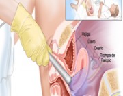 ¿Cómo se realiza la ecografía transvaginal?