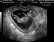 ¿Por qué se realiza la ecografía transvaginal en el embarazo?