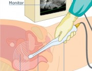 ¿Qué es la ecografía transvaginal?