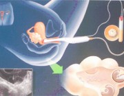 Ecografía transvaginal:¿Existe algún riesgo para el bebé?