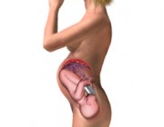 Síndrome de alcoholismo fetal