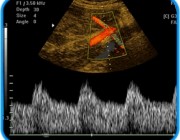 Diagnóstico de la placenta envejecida