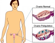 Infertilidad, sobrepeso y el síndrome del ovario poliquístico
