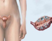 Tratamiento para el síndrome del ovario poliquístico