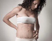 ¿Es normal el dolor de la cicatriz de la cesárea?