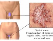 Virus del Papiloma Humano:¿Cuál es el tratamiento?