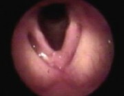 ¿Qué ocasiona el virus del papiloma humano en el bebé?