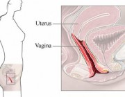 ¿Cómo prevenir una infección vaginal en el embarazo?