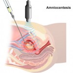 Pruebas embarazo: amniocentesis