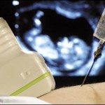 La amniocentesis es una prueba rápida