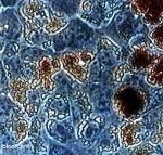 Paciente con células cancerígenas