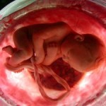 Cordón umbilical contra la leucemia