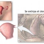 Grafico de una histerectomía