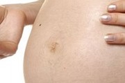 Trucos, cremas y ejercicios para prevenir las estrías