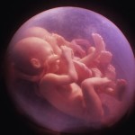 La placenta envejecida se relaciones con los embarazoas múltiples