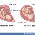 Placenta previa