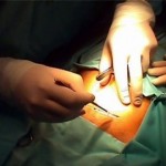 Adherencias abdominales