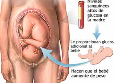 Diabetes gestacional: riesgos para el bebé