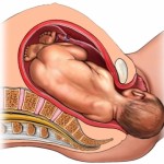 La distocia de hombros se produce cuando los hombros del bebe se atoran y no pueden salir
