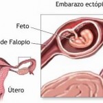 Un embarazo ectópico es cuando el embrión se desarrolla fuera del útero