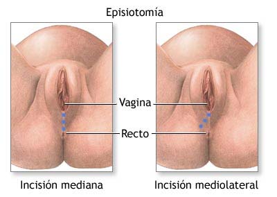 episiotomia