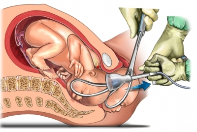 Gráfico de bebe retirado con fórceps y bomba de succión 