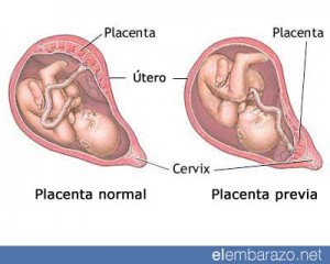 placenta-previa1
