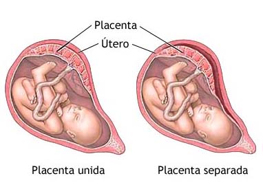 El desprendimiento de la placenta es uno de los resultados de los polihindramnios