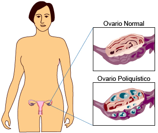 ovarios poliquístico