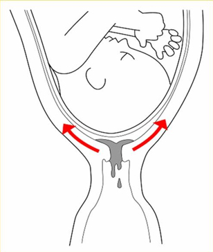 tapón mucoso