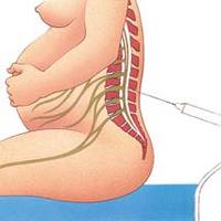 Anestesia epidural