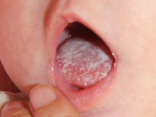 candidiasis bucal