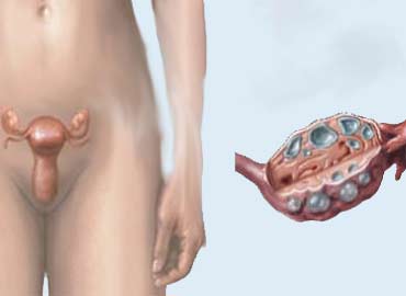 Sindrome del ovario poliquístico