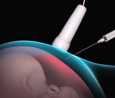 ¿La amniocentesis es dolorosa para el bebé?